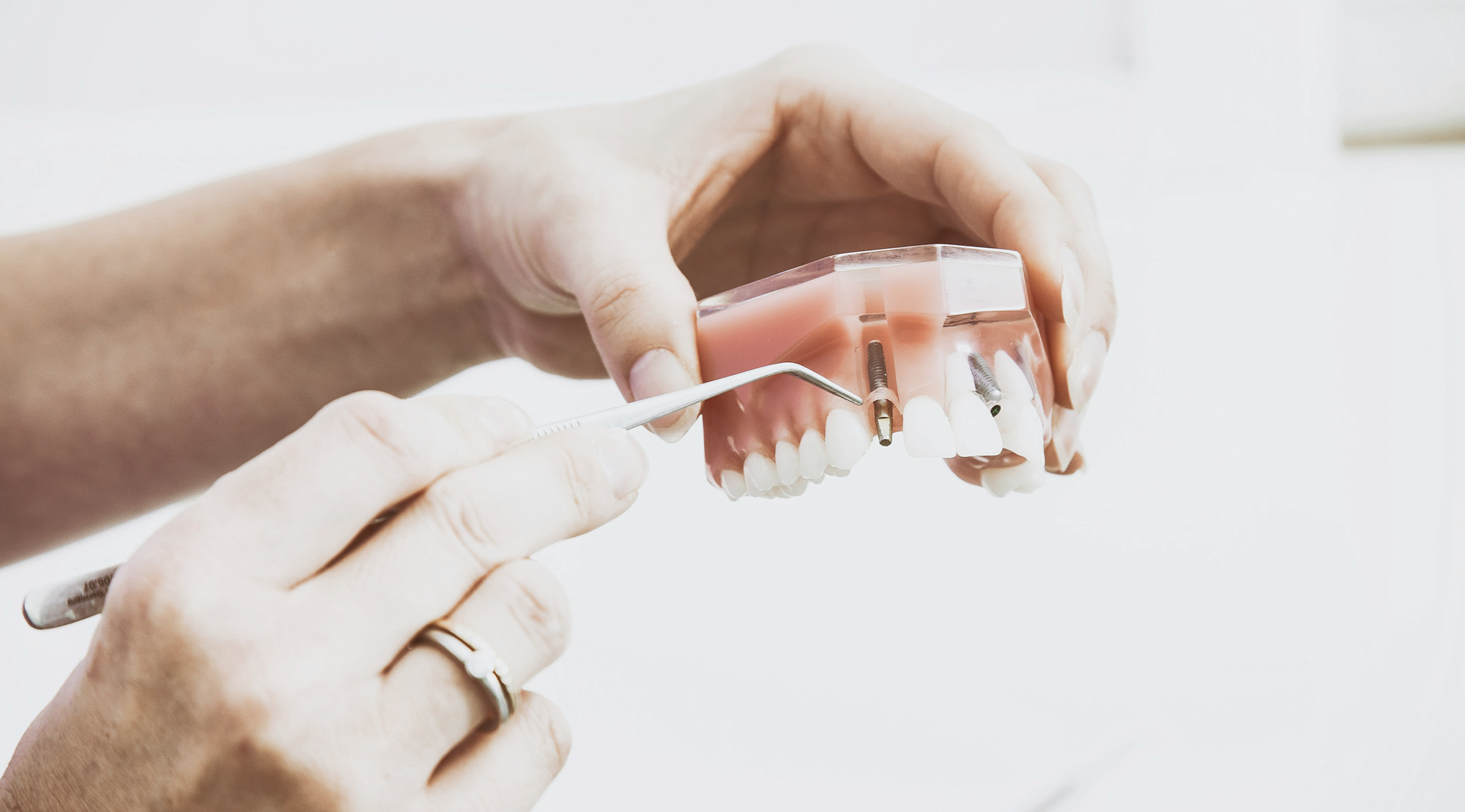 Implantologia: denti fissi, stabili e naturali