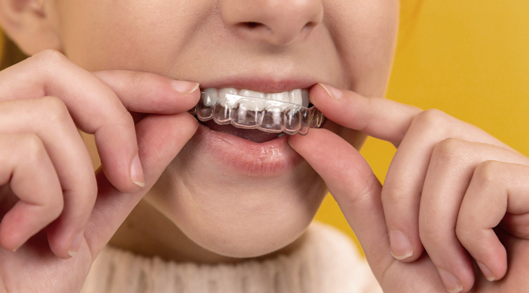 Ortodonzia e Invisalign: denti allineati, senza farsi notare